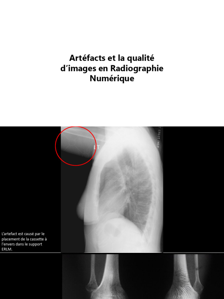 Artéfacts en Radiographie Numérique | PDF