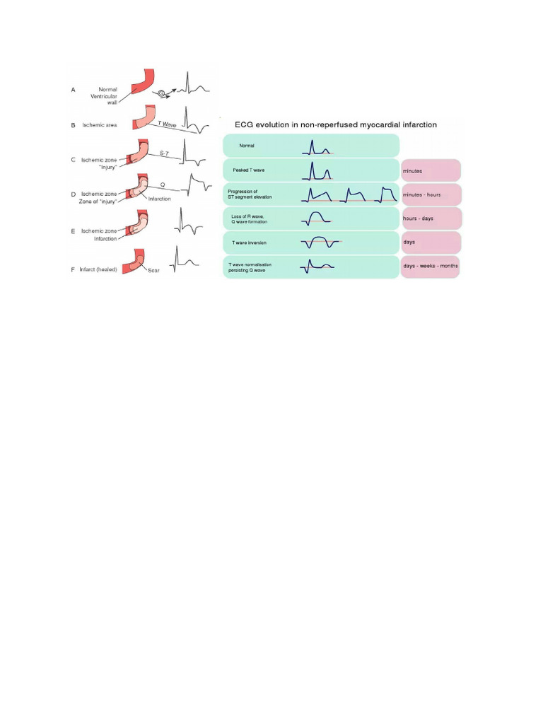 Changes in The ECG During An Evolving STEMI Reflect Differences in The ...