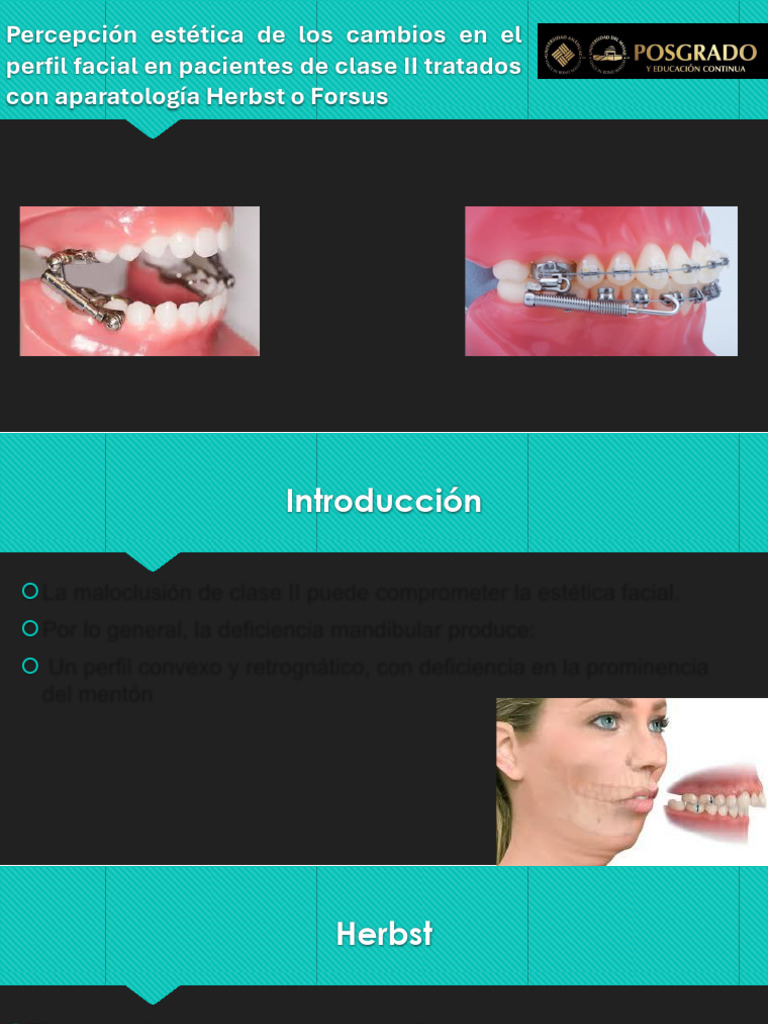 Estética facial en Clase II: Herbst vs Forsus | PDF | Ortodoncia | Medicina