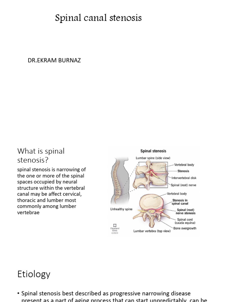 SPINAL STENOSIS 2 | PDF | Vertebral Column | Musculoskeletal System