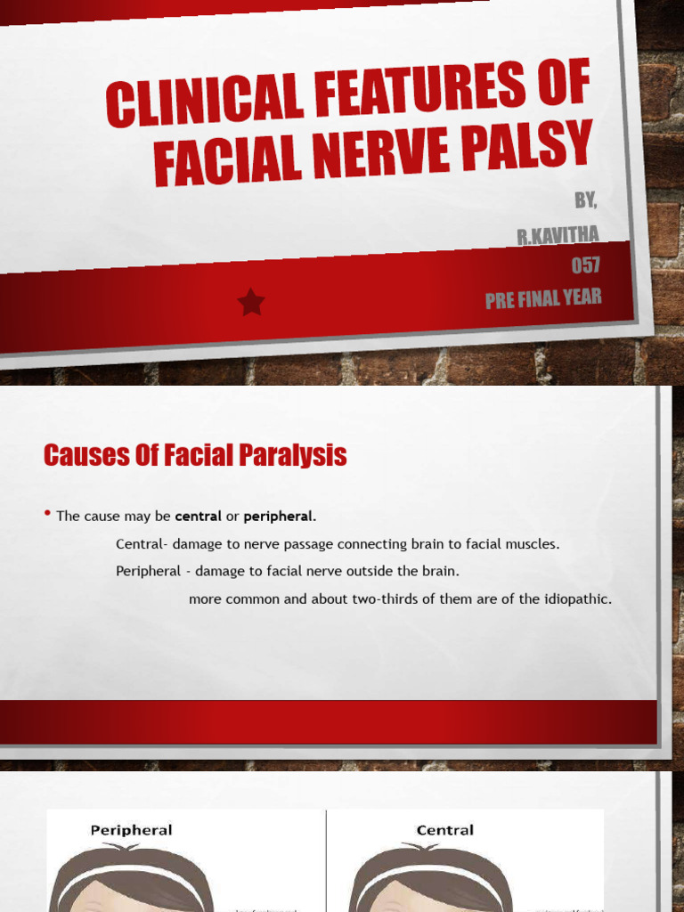Causes of Facial Nerve Palsy | PDF