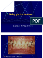 Onlay Partial Denture