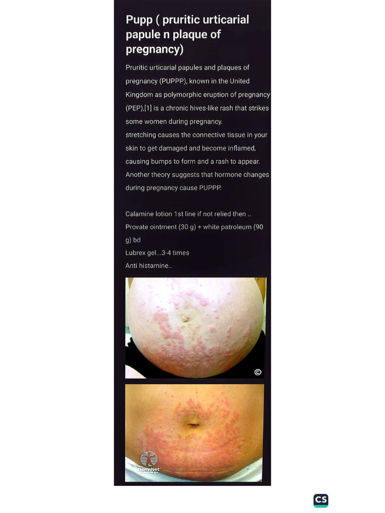 Pupp Pruritic Urticarial Papule N Plaque of Pregnancy | PDF