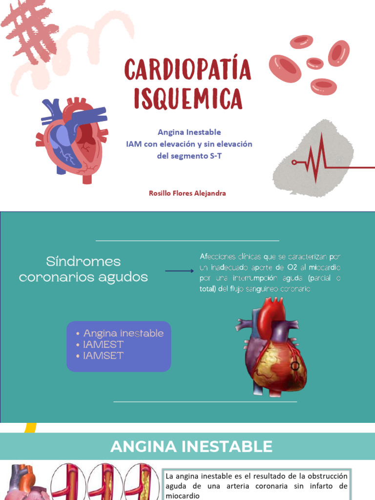 Expo Mi | PDF | Infarto de miocardio | Isquemia