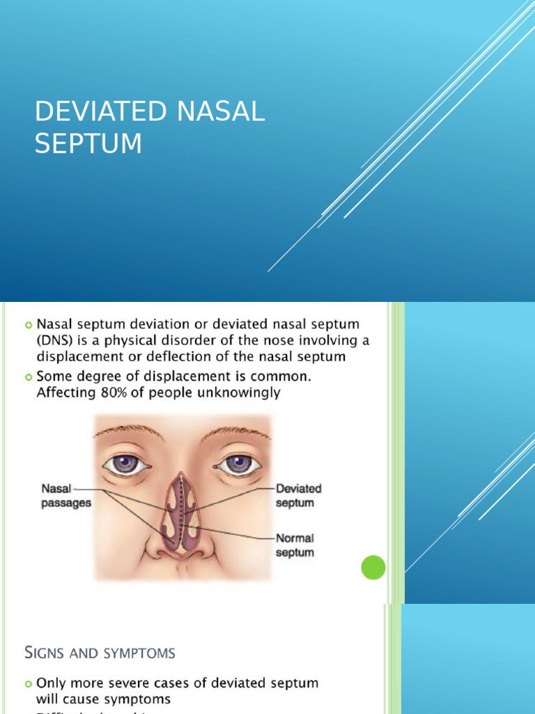 Deviated Nasal Septum | PDF