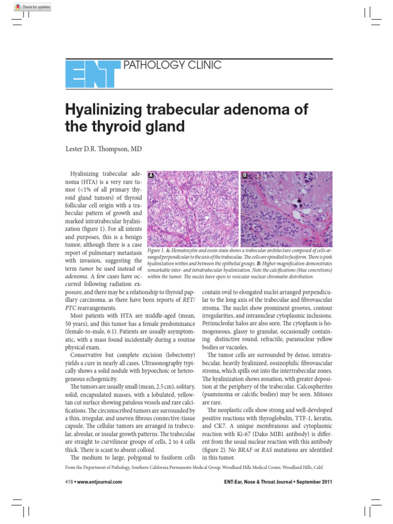 ENTJ-2011-09_Hyalinizing trabecular adenoma of the thyroid gland | PDF ...