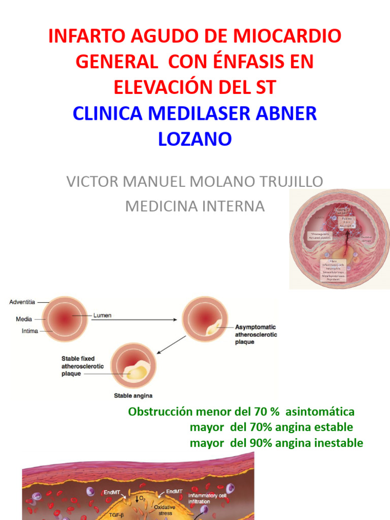 Iamcest Guias | PDF | Infarto de miocardio | Sistema cardiovascular