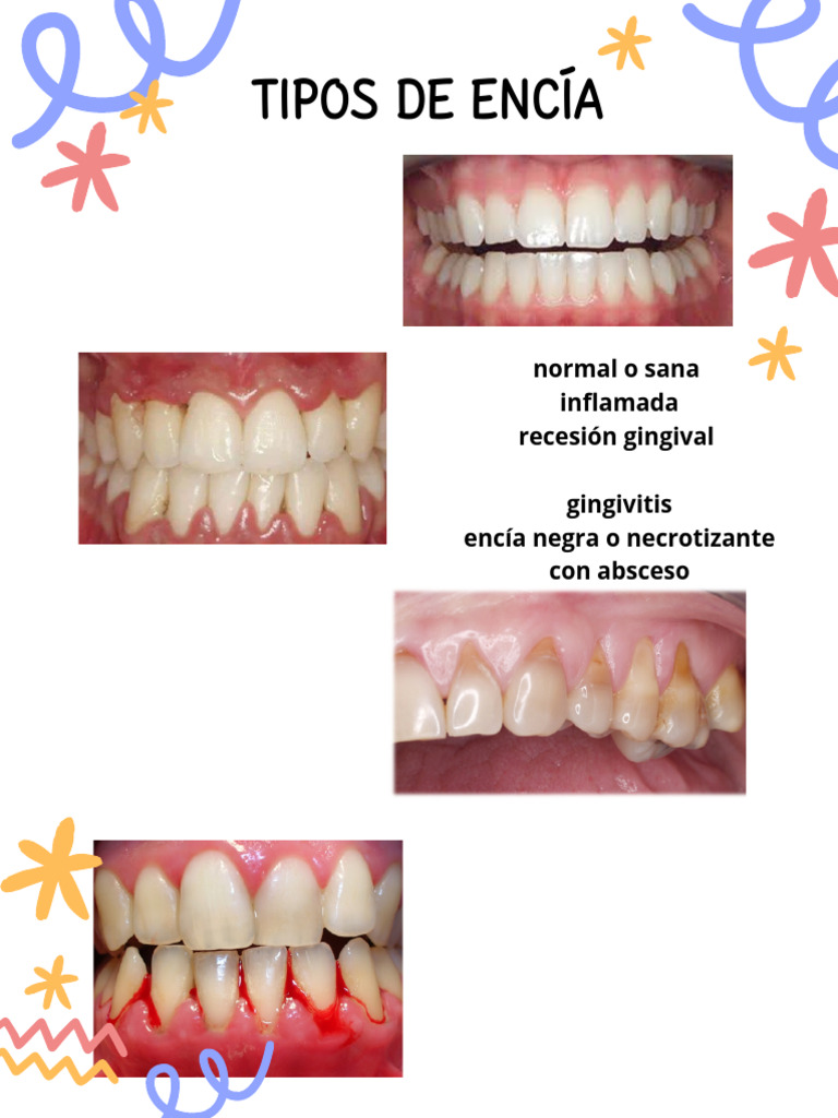Tipos de Encía | PDF