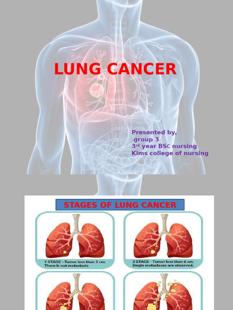 LUNG CANCER group3 3RD YEAR BSc (1) | PDF | Lung Cancer | Neoplasms