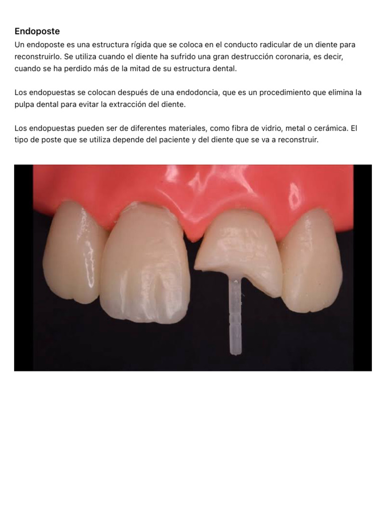Endoposte | PDF