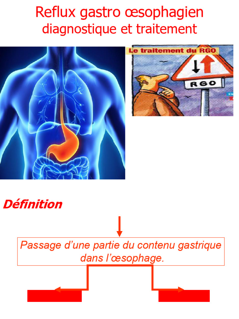 Diagnostic et traitement du RGO | PDF | Reflux gastro-œsophagien ...