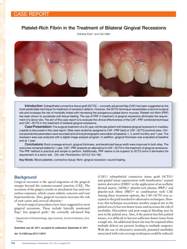Platelet Rich Fibrin in The Treatment of | PDF | Dentistry Branches ...
