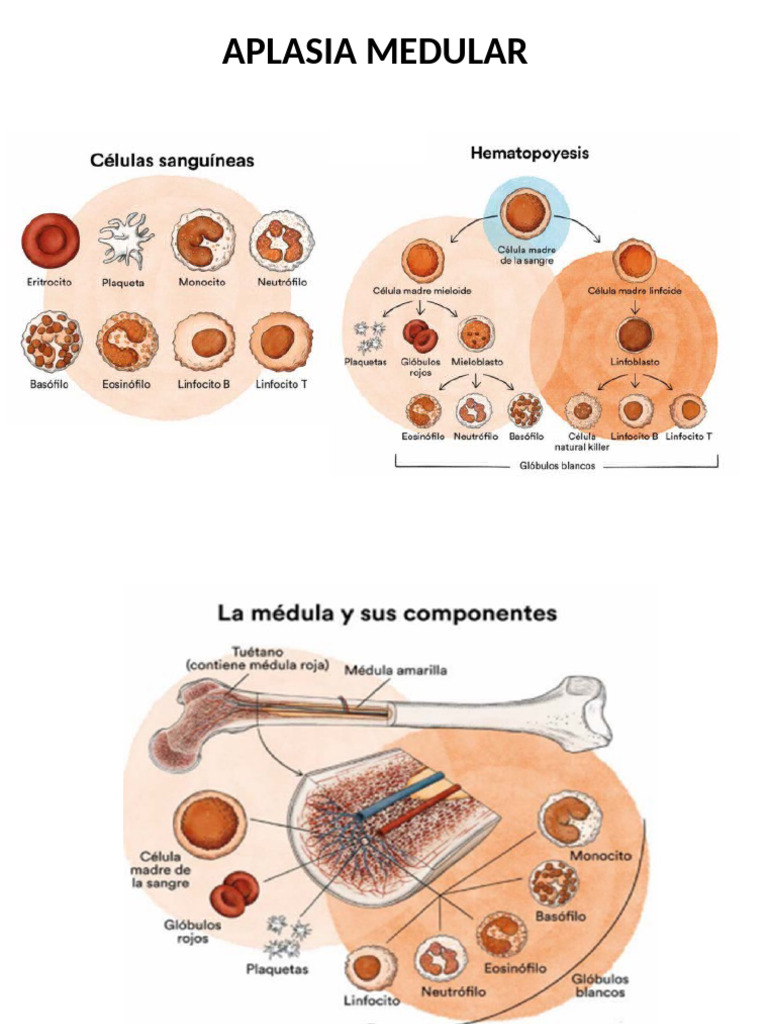 Aplasia Medular | PDF