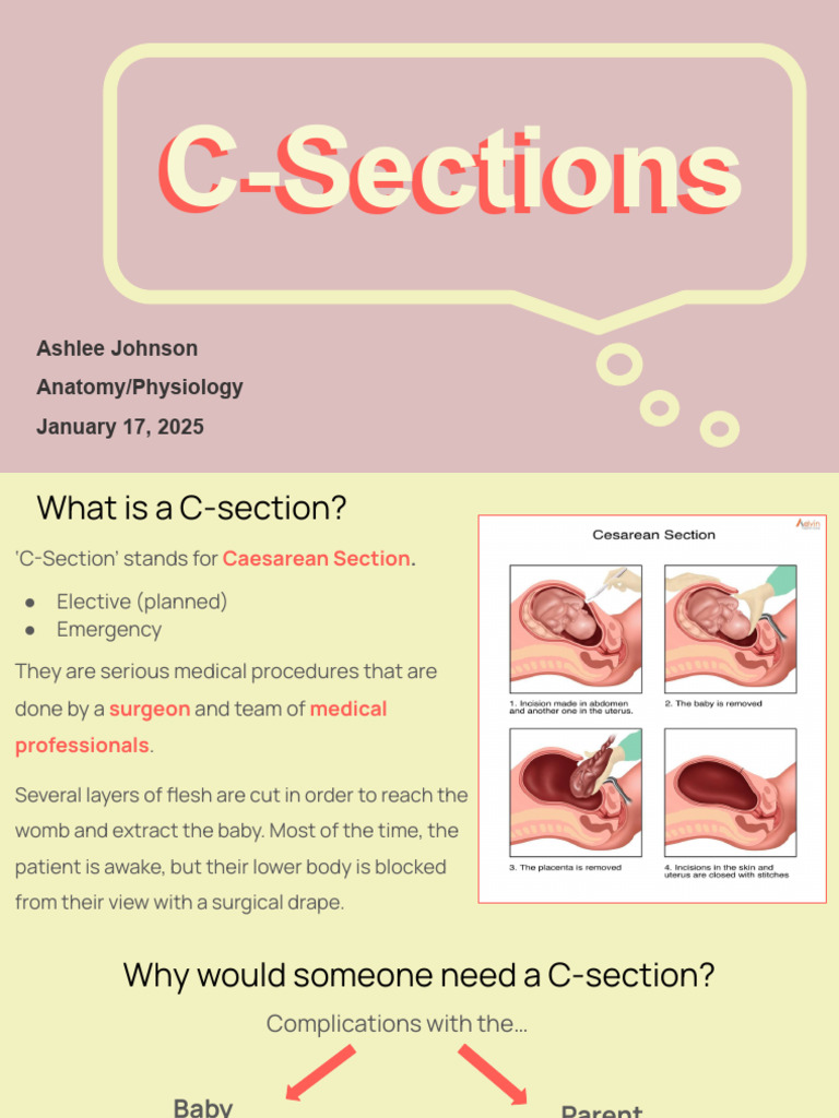 C-Section Presentation AshJ | PDF | Caesarean Section | Childbirth