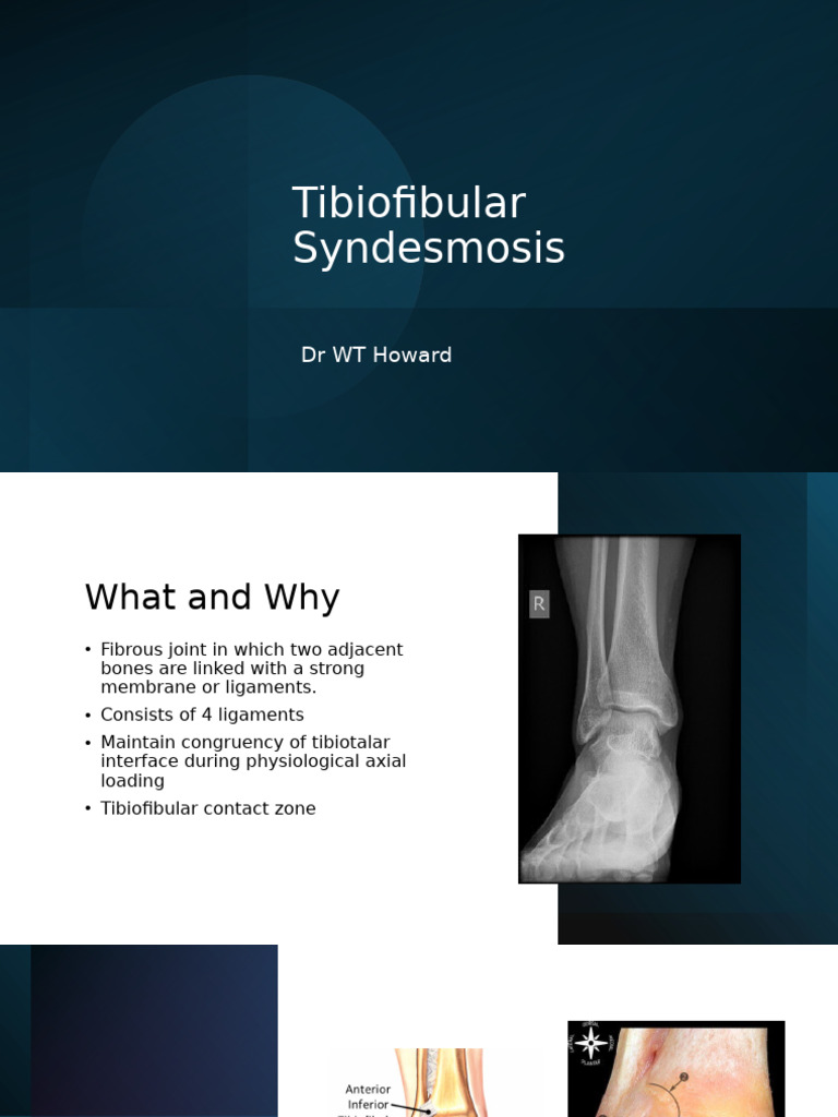 Tibiofibular Syndesmosis | PDF