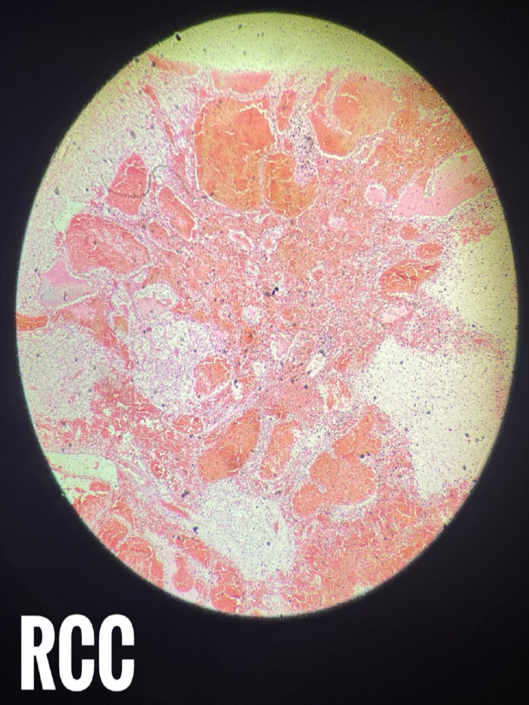 Patho-RCC, Papillary Thyroid CA | PDF