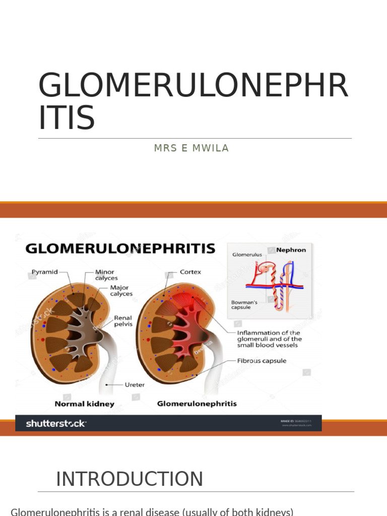 Overview of Glomerulonephritis Management | PDF | Kidney | Kidney Disease