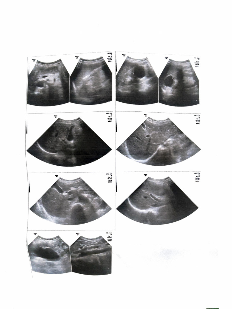 Abdominal Ultrasound Report Summary | PDF
