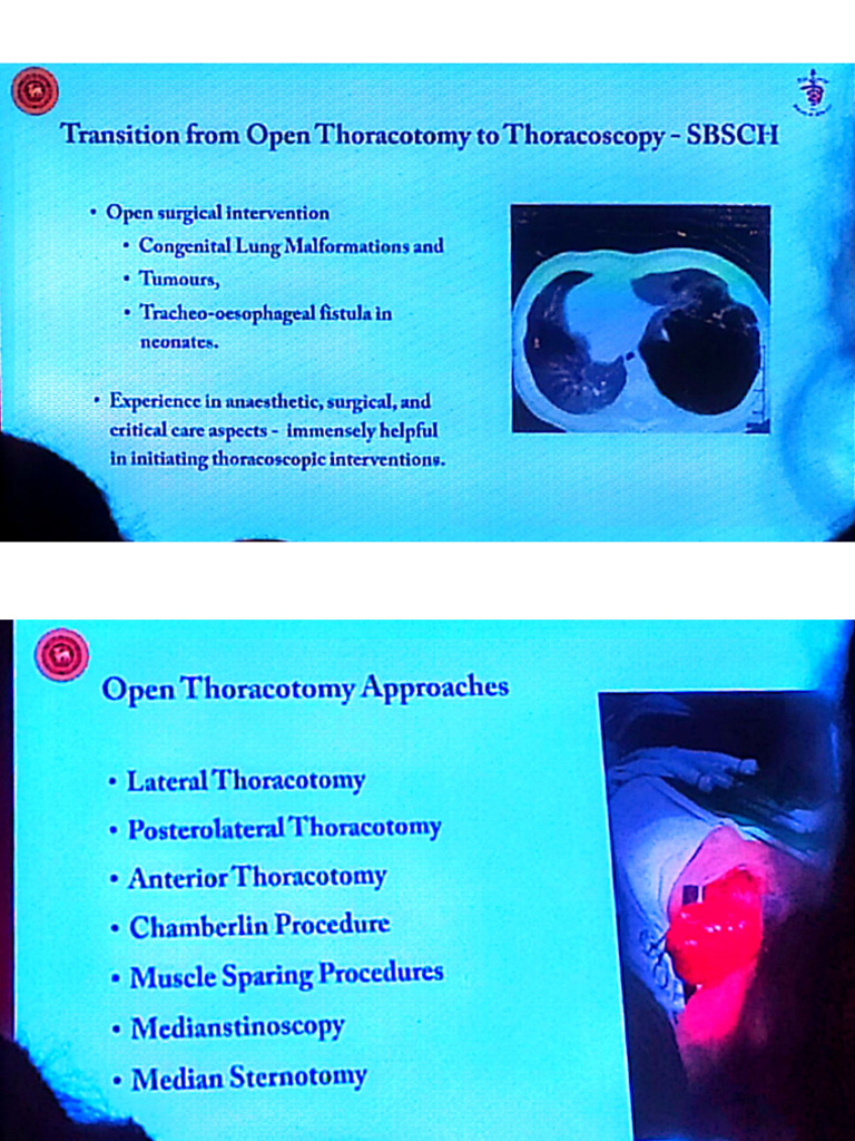 Video Assisted Thoracic Surgery | PDF