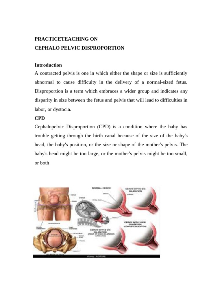 Contracted Pelvis And Cephalopelvic Disproportion