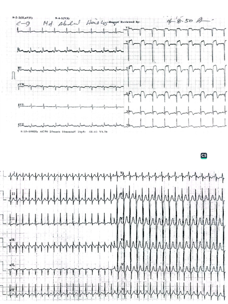 Ecg PDF | PDF