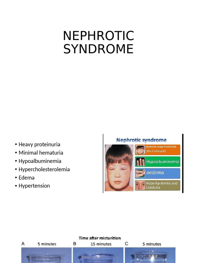 Nephrotic Syndrome 2021 | PDF | Clinical Medicine | Kidney