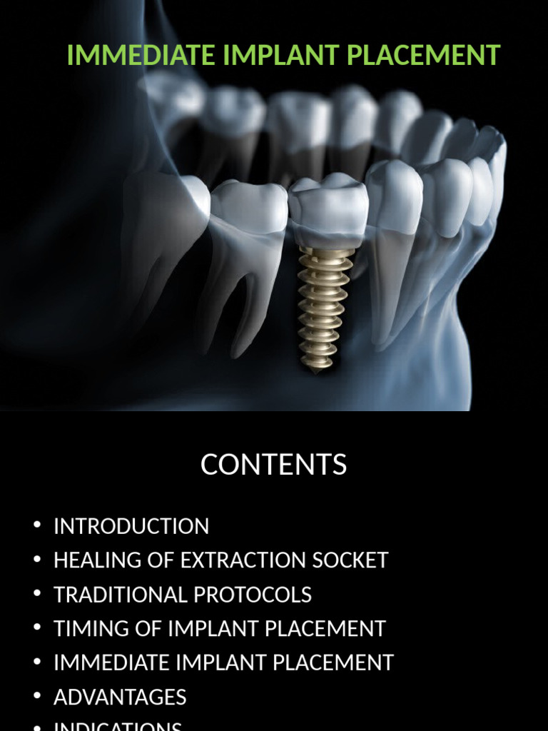 Immediate Implant Placement Guide | PDF | Dental Implant | Human Tooth