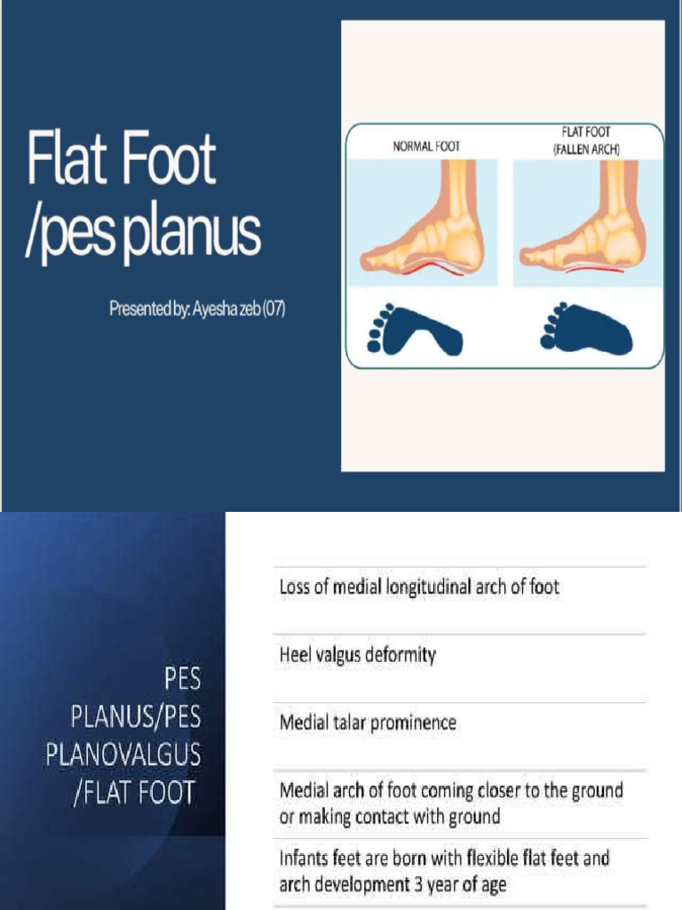 Flat Foot | PDF