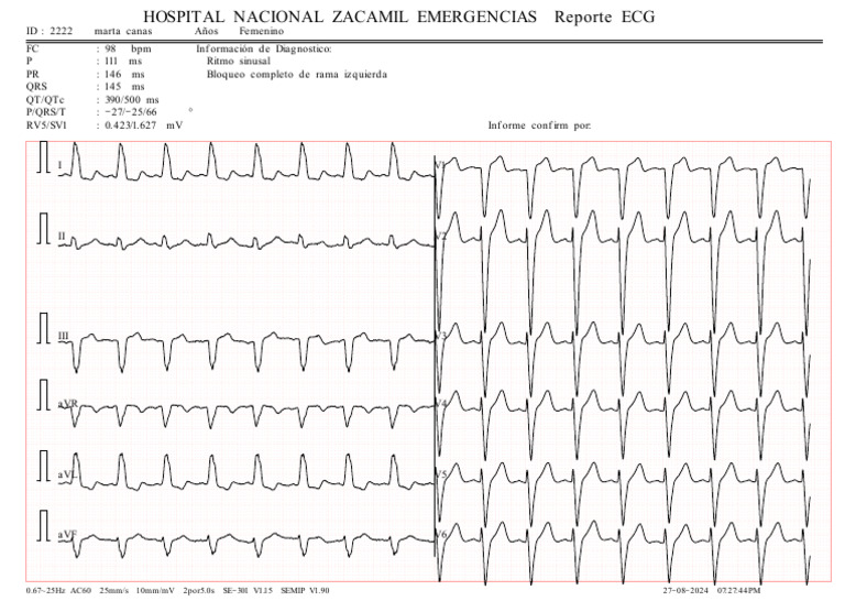Ekg Marta Rauda | PDF