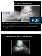 Proyecciones Calcaneo Broden