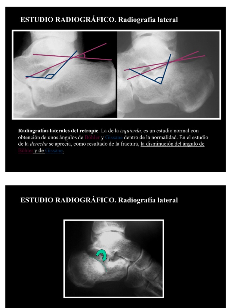Proyecciones Radiográficas del Calcáneo | PDF | Sistema ...