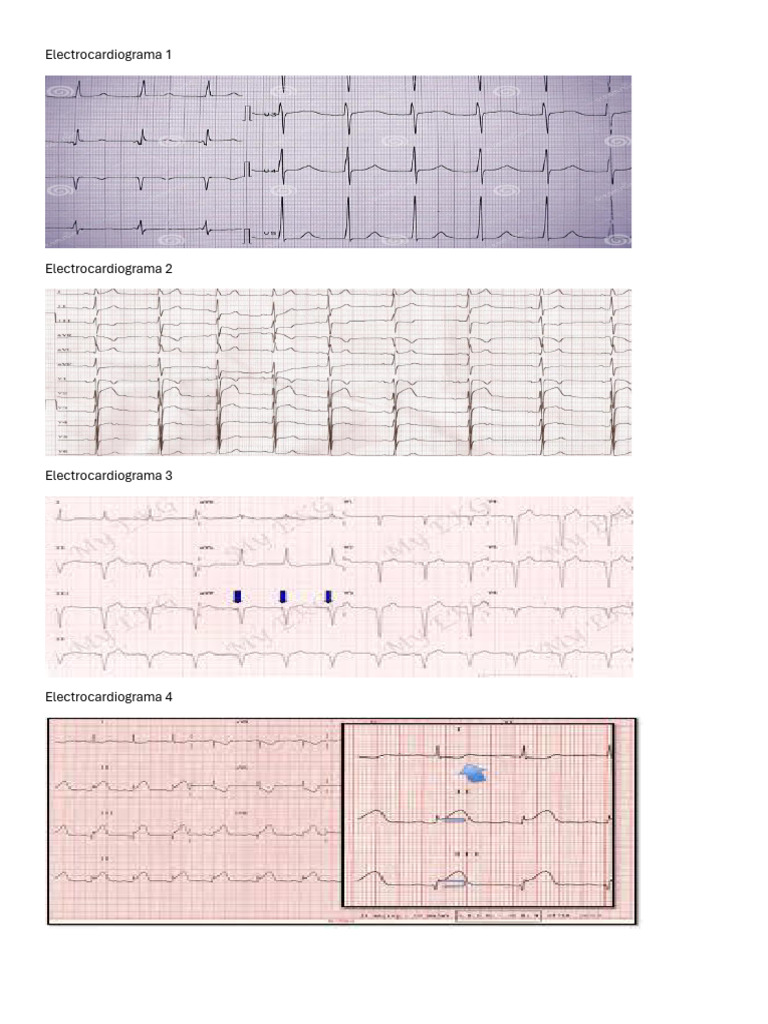 Electrocardiograma 1 | PDF