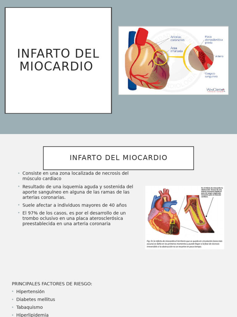 Infarto Del Miocardio | PDF | Infarto de miocardio | Especialidades Medicas