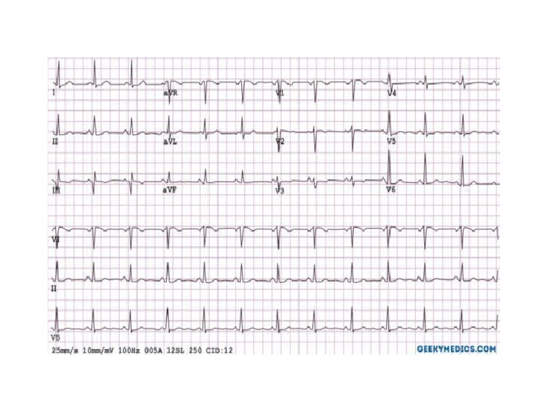 ECG | PDF