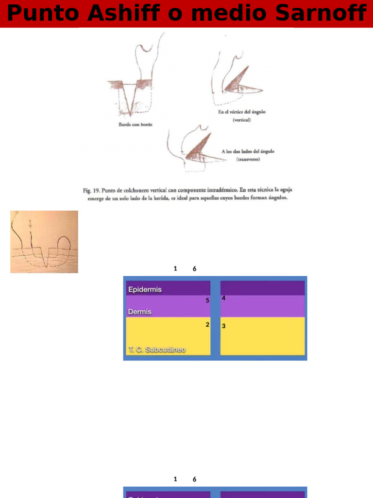 Punto Ashiff o Medio Sarnoff | PDF