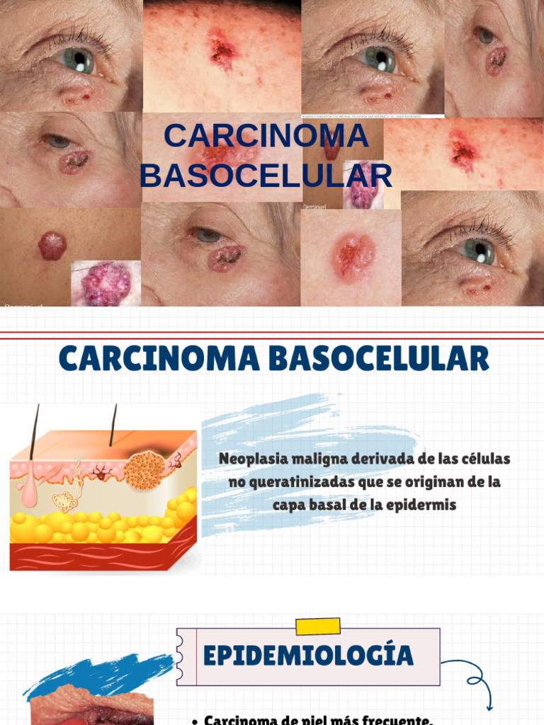 Carcinoma Basocelular: Guía Esencial | PDF