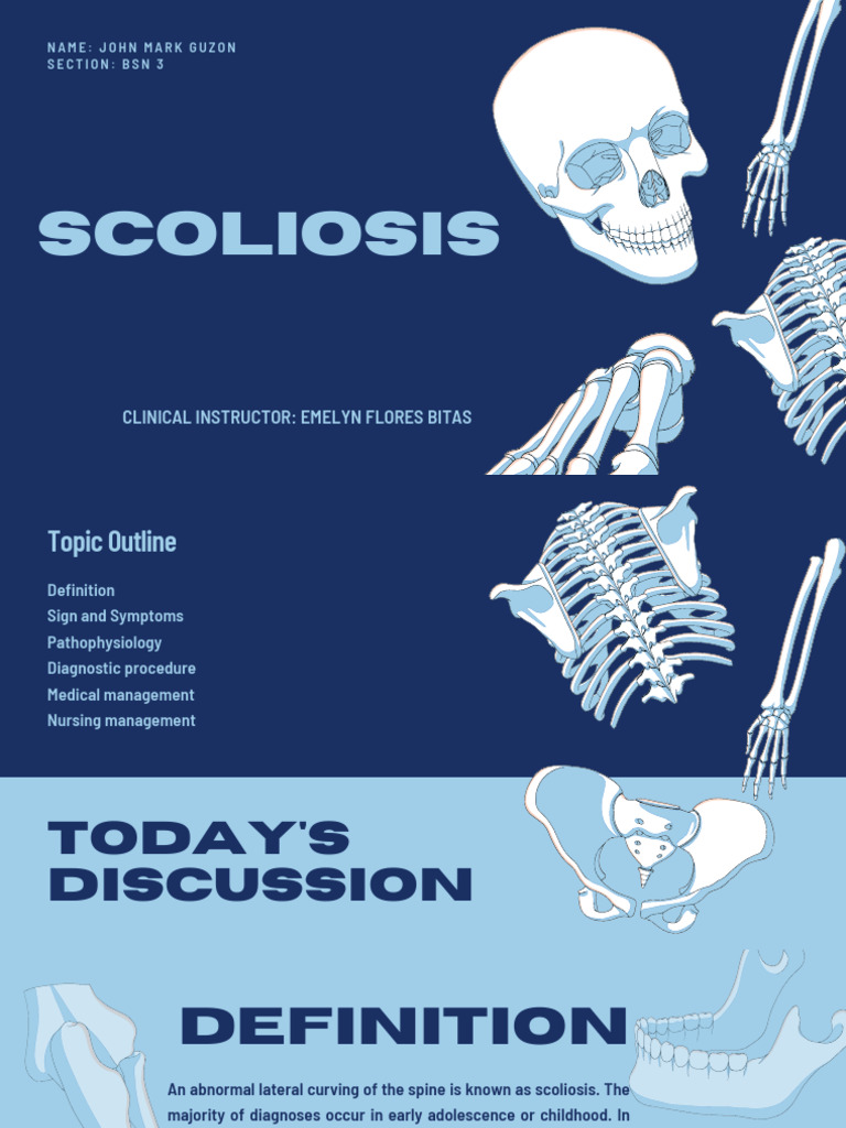 Scoliosis Pdf Scoliosis Vertebral Column