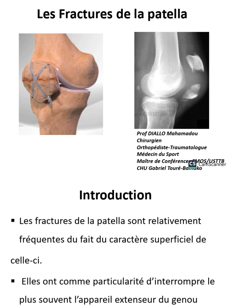 Fractures de la Patella : Diagnostic et Traitement | PDF | Genou ...