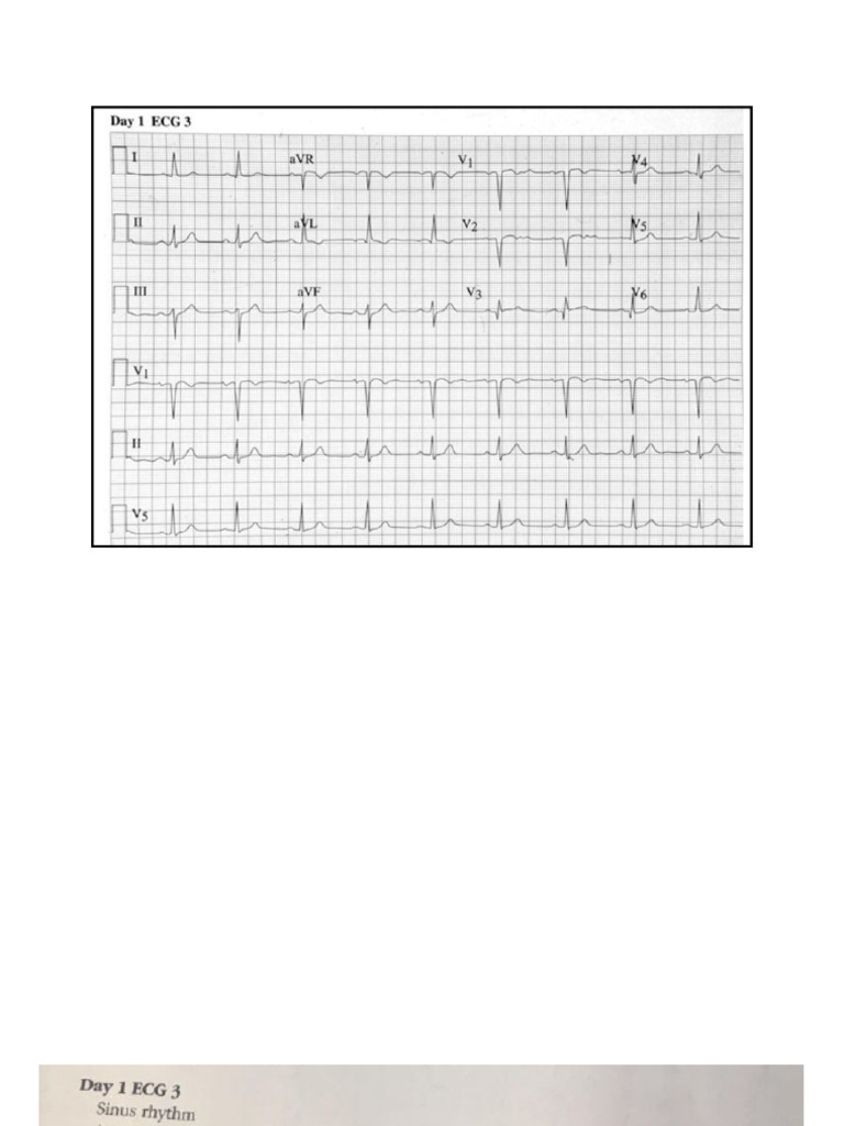 ECG Seminars With Answers | PDF