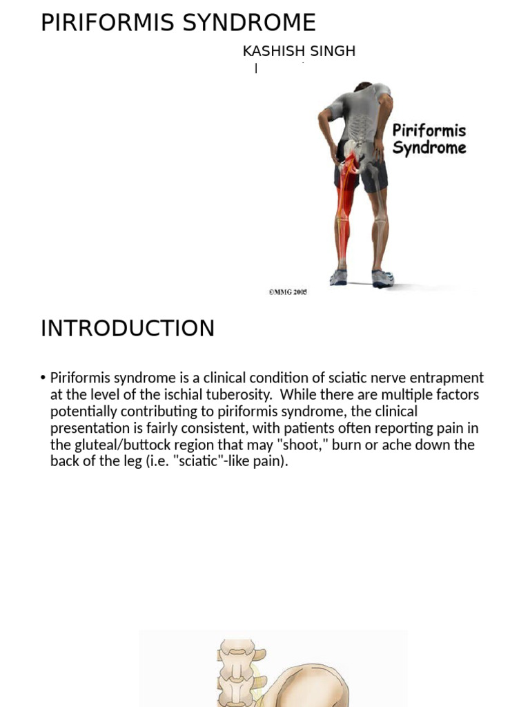 Piriformis Syndrome-1 | PDF | Anatomical Terms Of Motion | Nervous System