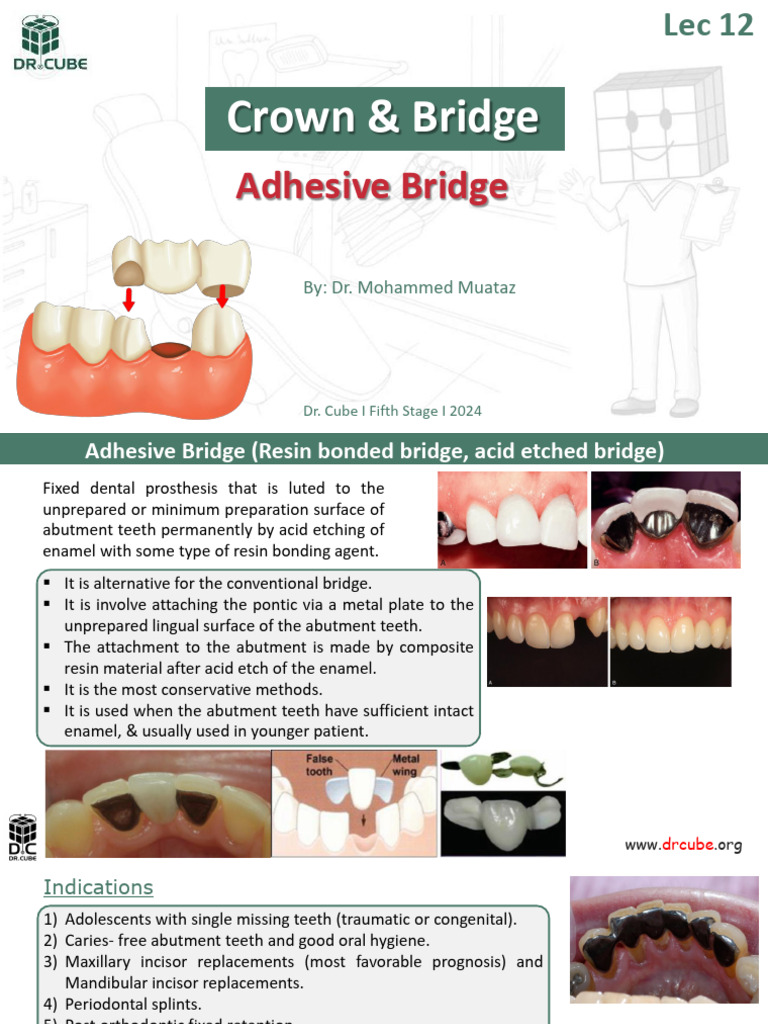 Adhesive Bridge in Fixed Prosthodontics | PDF | Medical Specialties ...