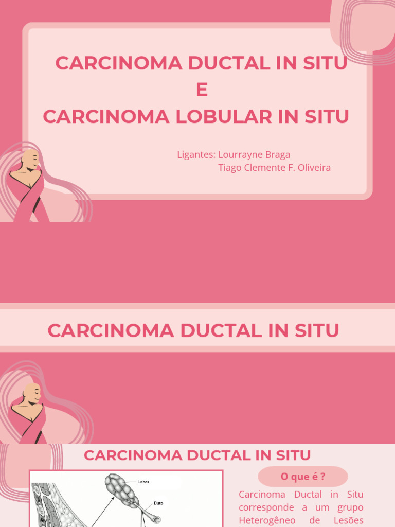 Carcinoma Ductal e Lobular in Situ | PDF | Câncer de mama | Carcinoma