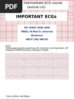 Right Ventricular Hypertrophy (RVH) - LITFL - ECG Library Diagnosis ...