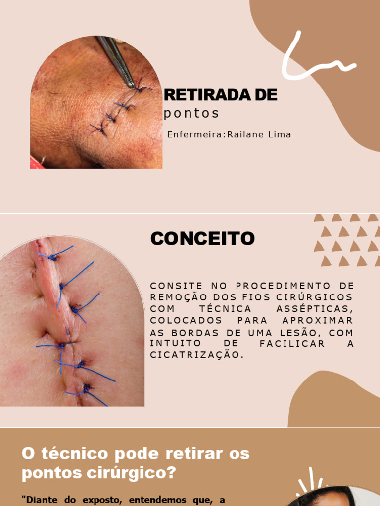 Retirada de Pontos Cirúrgicos: Guia Prático | PDF | Enfermagem ...