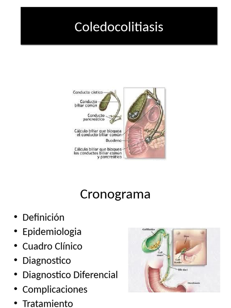 Coledocolitiasis: Diagnóstico y Tratamiento | PDF | Enfermedades y ...