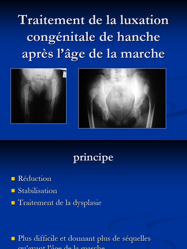 Traitement de la luxation congénitale de la hanche | PDF | Orthopédie ...