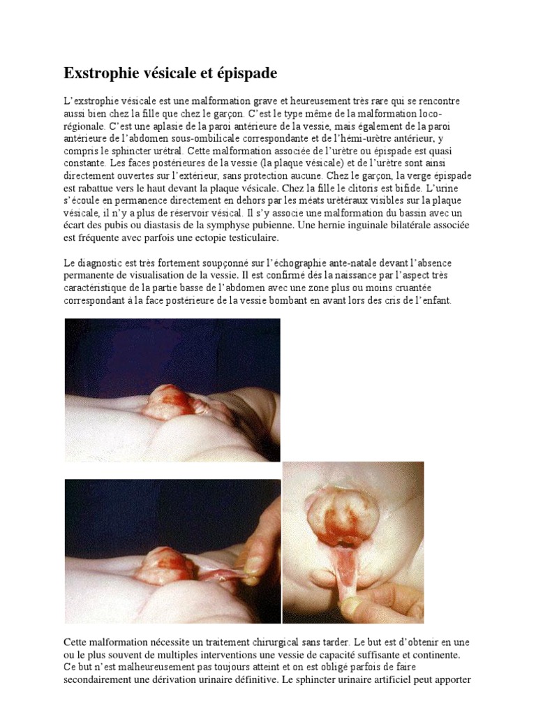 Exstrophie Vésicale Et Épispade | Descargar gratis PDF | Vessie ...