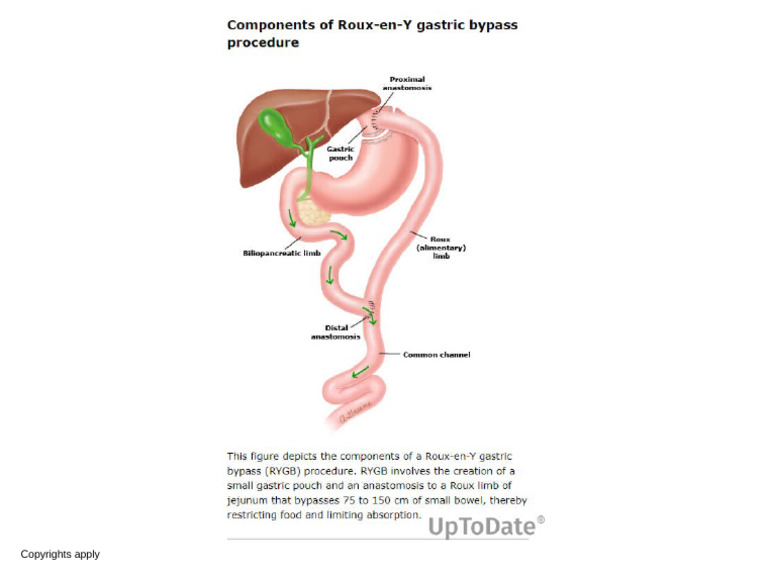 Components of Roux en Y Gastric Bypass Procedure | PDF