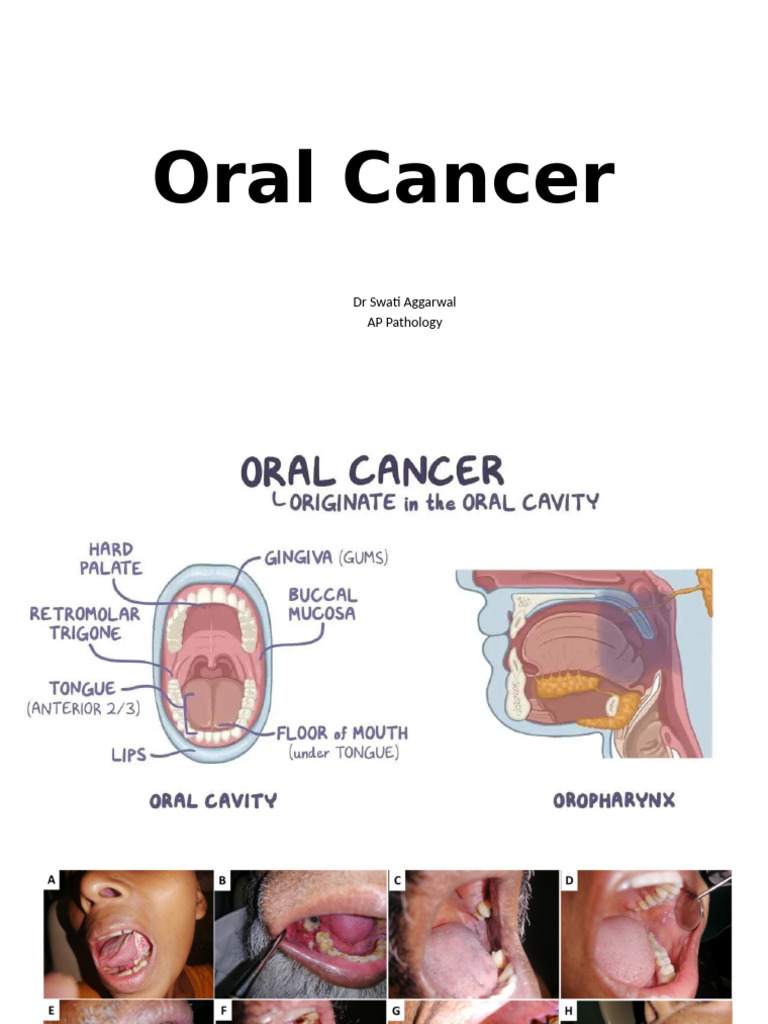 Oral Cancer Pathogenesis Explained | PDF