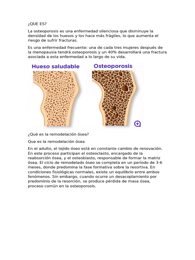 Guía Completa sobre la Osteoporosis | PDF | Osteoporosis | Hueso